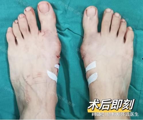 拇外翻手术过程视频,专业解析与康复指导